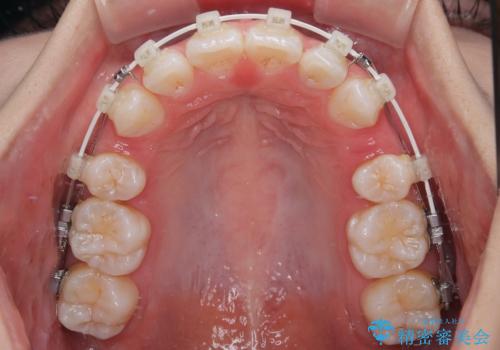 斜め前に飛び出した前歯 抜歯矯正で素敵な横顔にの治療中