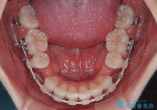 斜め前に飛び出した前歯 抜歯矯正で素敵な横顔にの治療中