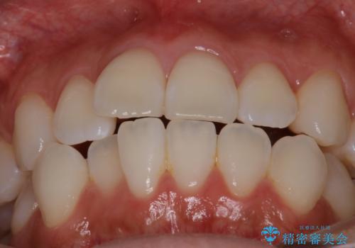 【インビザライン】右側のがたつき治したいの治療前