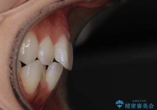 【インビザライン】右側のがたつき治したいの治療前