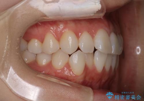 【インビザライン】右側のがたつき治したいの治療前