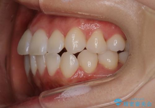 【インビザライン】右側のがたつき治したいの治療前