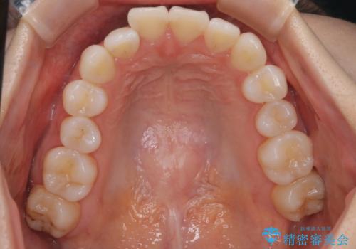 【インビザライン】右側のがたつき治したいの治療前