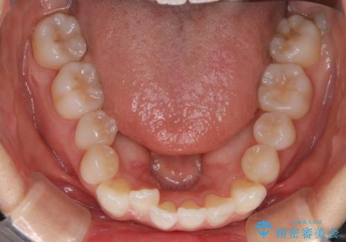 【インビザライン】右側のがたつき治したいの治療前