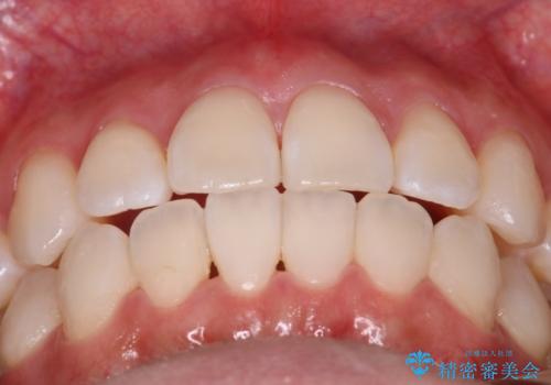 【インビザライン】右側のがたつき治したいの治療後