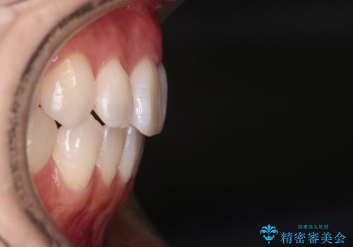 【インビザライン】右側のがたつき治したいの治療後