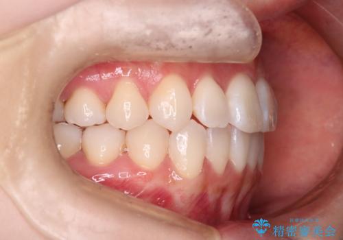 【インビザライン】右側のがたつき治したいの治療後