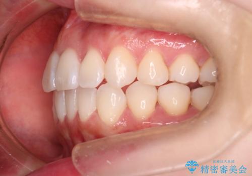 【インビザライン】右側のがたつき治したいの治療後