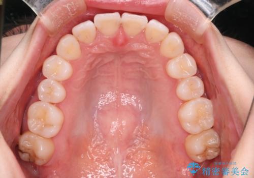 【インビザライン】右側のがたつき治したいの治療後