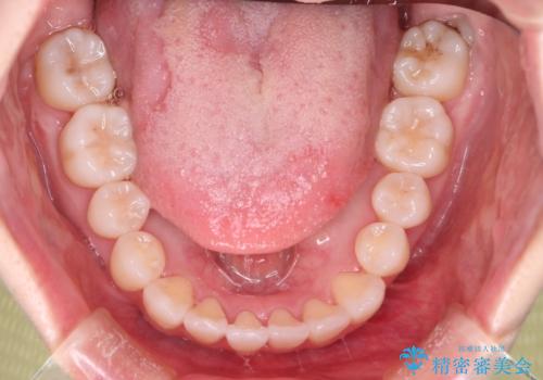 【インビザライン】右側のがたつき治したいの治療後