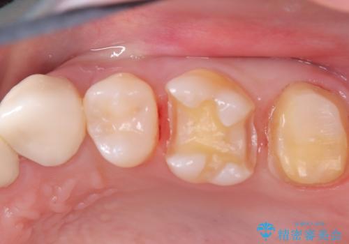虫歯を治したい〈セラミック〉の治療中