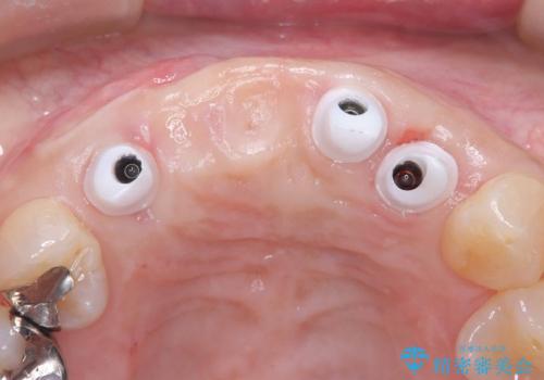 歯茎の腫れが気になる方必見!|抜歯即時インプラントで前歯5本を痛みなく3か月で治療完了!の治療後