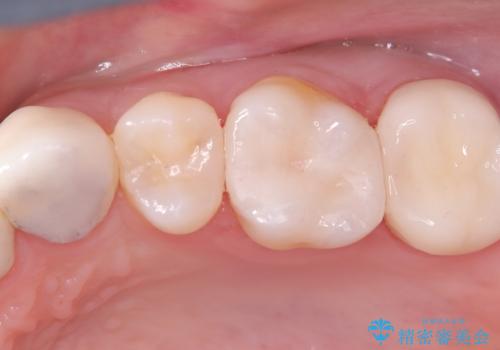 虫歯を治したい〈セラミック〉の治療後