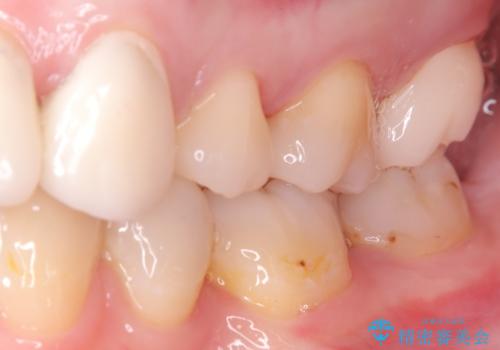 虫歯を治したい〈セラミック〉の症例 治療後