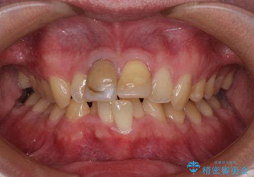 保険治療後の見た目が気になる方へ|セラミッククラウンで美しく自然な仕上がりにの症例 治療前