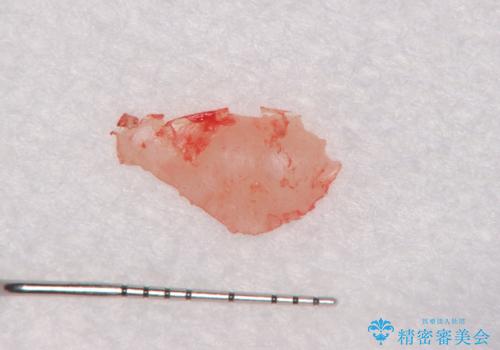 骨隆起を取りたいの治療後