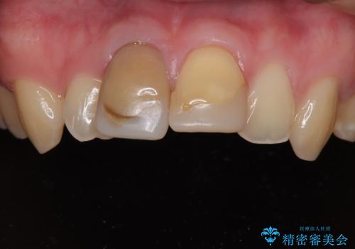 保険治療後の見た目が気になる方へ|セラミッククラウンで美しく自然な仕上がりにの治療前