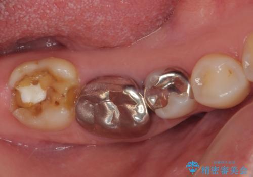 右下の銀歯が外れた オールセラミッククラウンの症例 治療前