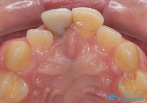 保険治療後の見た目が気になる方へ|セラミッククラウンで美しく自然な仕上がりにの治療前