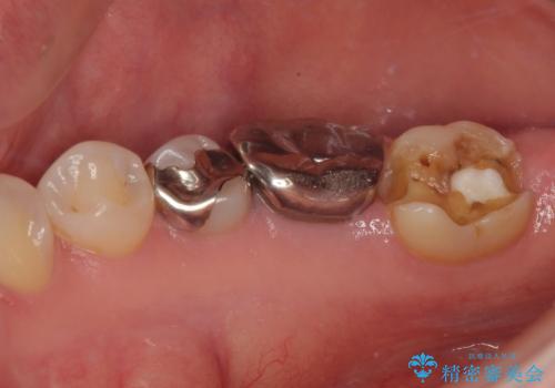 右下の銀歯が外れた オールセラミッククラウンの治療前
