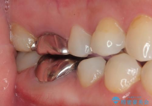 右下の銀歯が外れた オールセラミッククラウンの治療前
