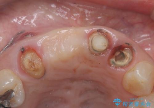 歯茎の腫れが気になる方必見!|抜歯即時インプラントで前歯5本を痛みなく3か月で治療完了!の治療前