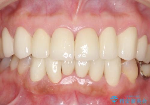 前歯クラウン(オールセラミック)の症例 治療後