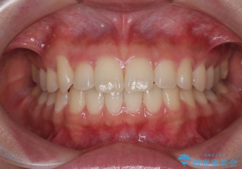 マウスピース矯正が煩わしい ワイヤー装置での非抜歯矯正の症例 治療後