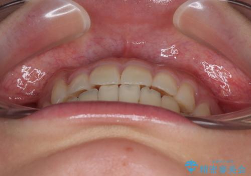 マウスピース矯正が煩わしい ワイヤー装置での非抜歯矯正の治療後