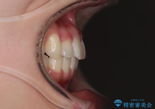 マウスピース矯正が煩わしい ワイヤー装置での非抜歯矯正の治療後