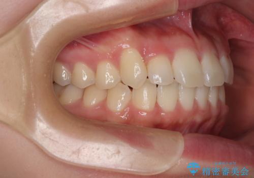 マウスピース矯正が煩わしい ワイヤー装置での非抜歯矯正の治療後