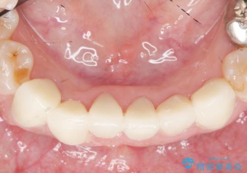 [ セラミック治療 ] 前歯の見た目を改善したいの治療後