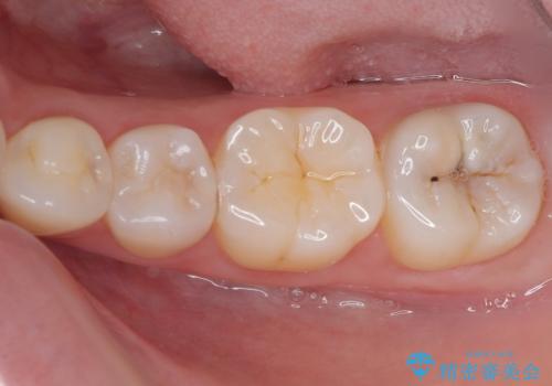 左下に虫歯が見つかった セラミックインレー修復の治療前