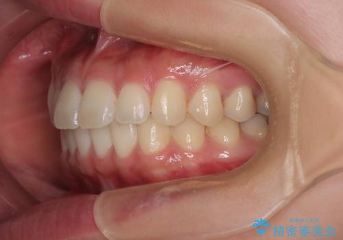 マウスピース矯正が煩わしい ワイヤー装置での非抜歯矯正の治療後