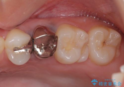 笑った時に目立つ銀歯を治したい オールセラミッククラウンの症例 治療前