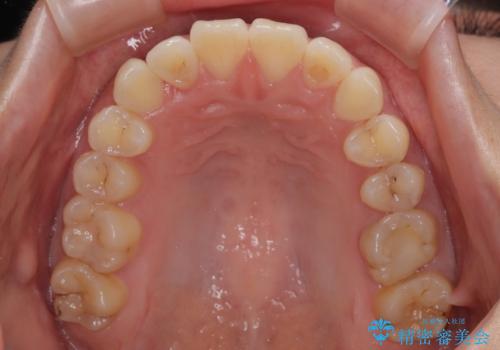 マウスピース矯正が煩わしい ワイヤー装置での非抜歯矯正の治療後