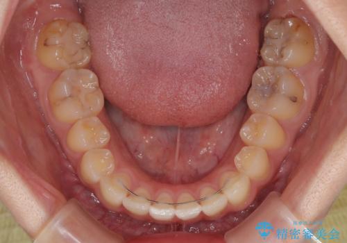 マウスピース矯正が煩わしい ワイヤー装置での非抜歯矯正の治療後