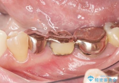 銀歯のブリッジをジルコニアブリッジへの治療前