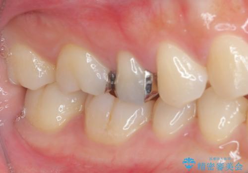 右上の銀歯を外したい ハイブリッドインレー修復の治療前