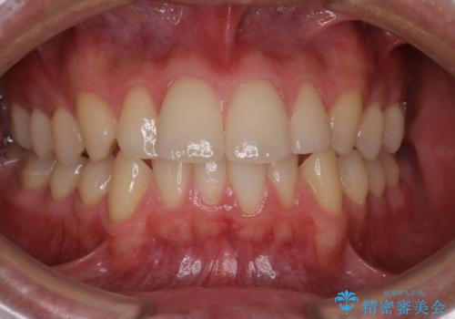 【インビザラインモニター】前歯が出ているのが気になるの症例 治療前