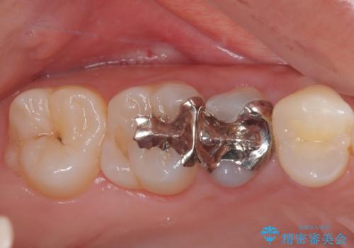 右上の銀歯を外したい ハイブリッドインレー修復の症例 治療前