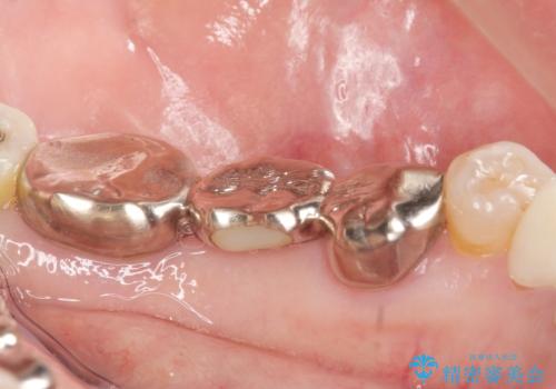 銀歯のブリッジをジルコニアブリッジへの治療前