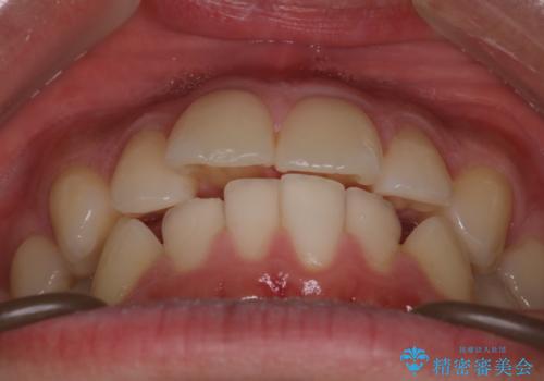 【インビザラインモニター】前歯が出ているのが気になるの治療前