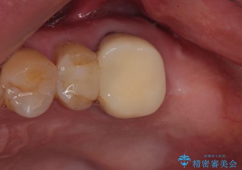 欠損した奥歯 インプラントによる補綴治療の治療前
