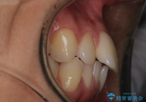 【インビザラインモニター】前歯が出ているのが気になるの治療前