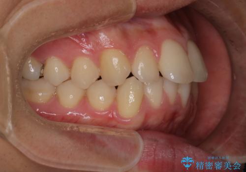 【インビザラインモニター】前歯が出ているのが気になるの治療前