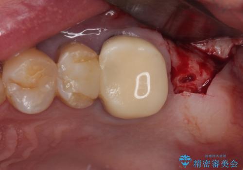 欠損した奥歯 インプラントによる補綴治療の治療中