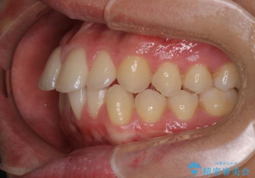 【インビザラインモニター】前歯が出ているのが気になるの治療前