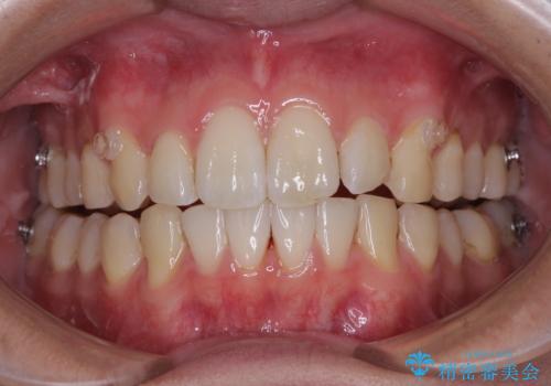 前歯のデコボコをインビザラインで綺麗に改善の治療中