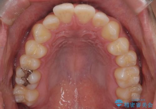 【インビザラインモニター】前歯が出ているのが気になるの治療前